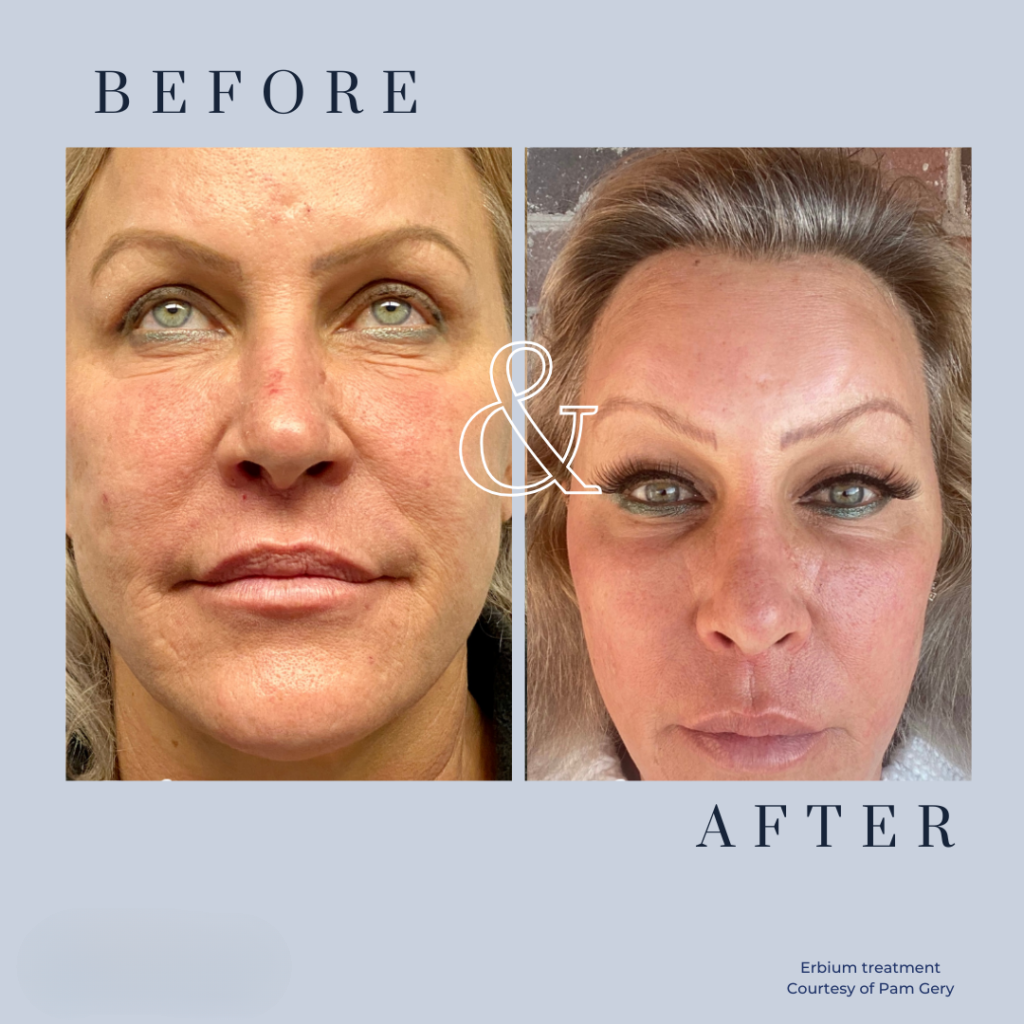 Nurse performing erbium laser facial treatment Denton TX