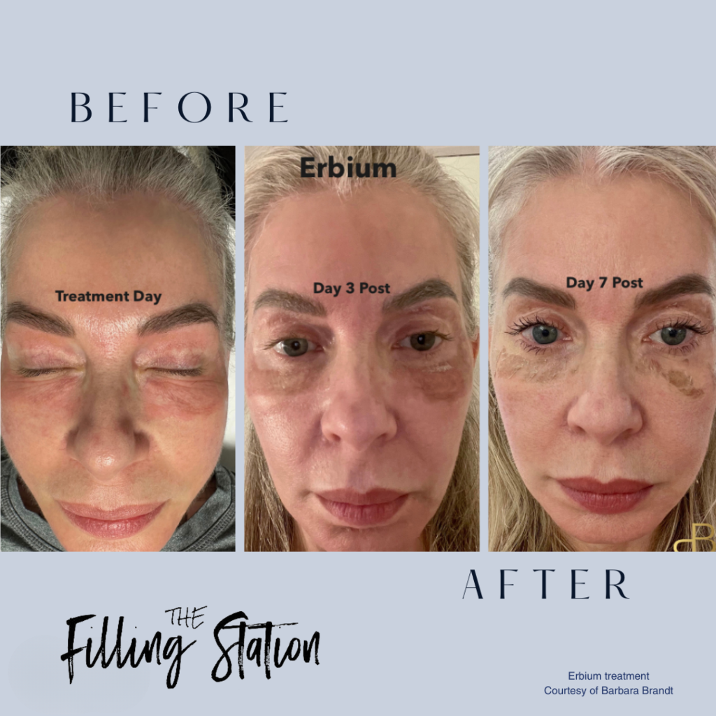 Erbium laser resurfacing treatment at The Filling Station Denton TX
